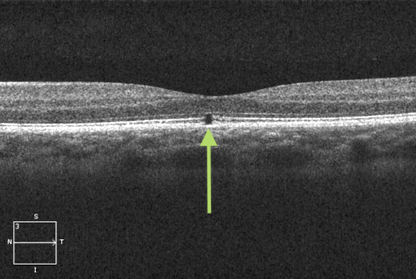 Laser injury OCT 56 micron